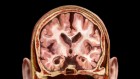 Dementia risk linked to blood-protein imbalance in middle age